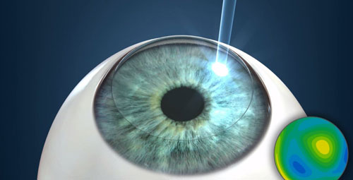 The different types of laser eye surgeries